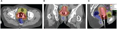 High-dose-rate brachytherapy in uterine cervix carcinoma: a comparison of dosimetry and clinical outcomes among three fractionation schedules